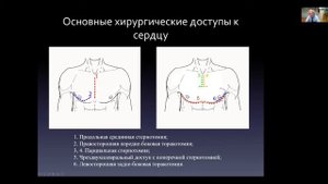 Доступы к сердцу. Кардиохирургия для кардиологов. БМ-2. Профессор Шихвердиев Н.Н.