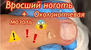 Вросший ноготь?⚠️? + Околоногтевая мозоль??❗️?