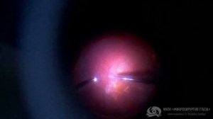 Старая воронкообразная отслойка сетчатки