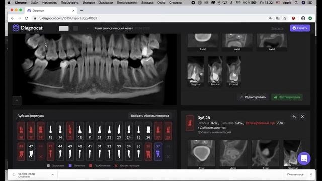 ДИАГНОКАТ. Искусственный интеллект для диагностики и интерпретации 3D дентальных снимков