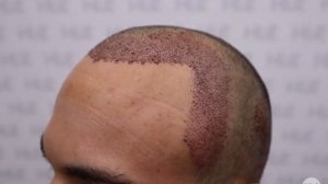 Лечение залысин пересадкой волос - Результат трансплантации 3630 графтов - Клиника HLC в Турции
