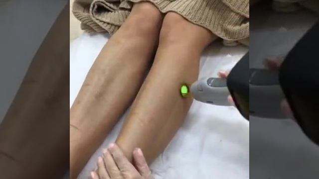 Лазерная эпиляция области голени ноги смотреть онлайн