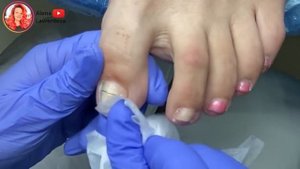 Помогаем клиентке, такие случаи в моей студии каждый день. Титановая нить!