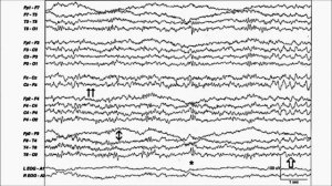 ЭЭГ сна. Часть 1