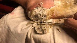 How to removal skin | callus removal skin flakes #53