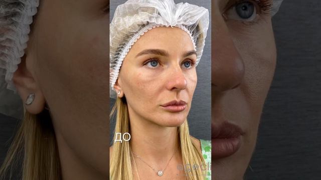 Казалось бы почти незаметные возрастные изменения, но как делают лицо уставшим и прибавляют возраст