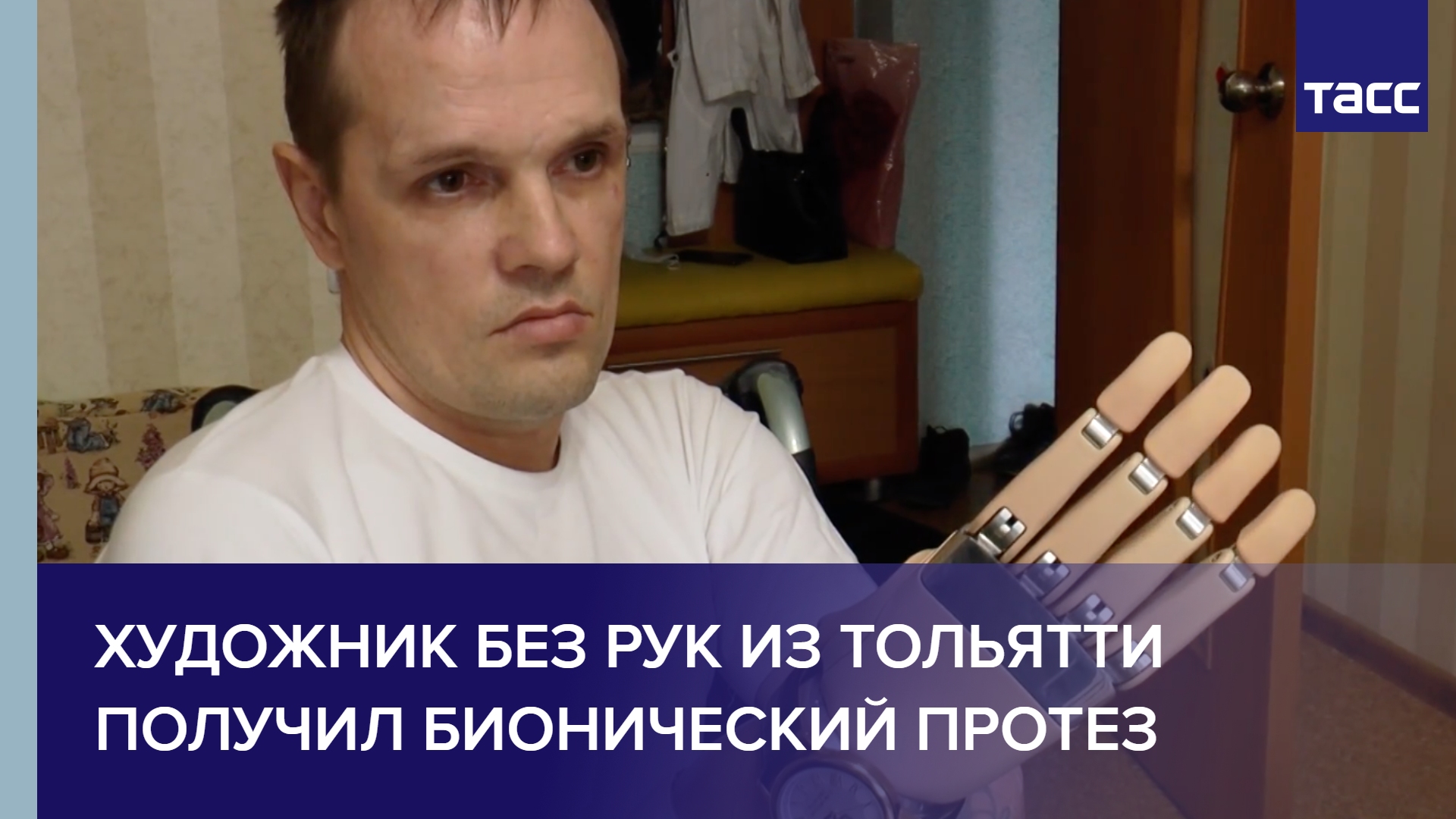 Художник без рук из Тольятти получил бионический протез