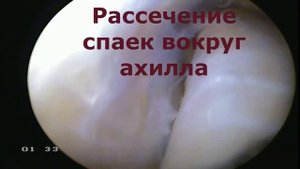 Лечение тендинита ахиллова сухожилия