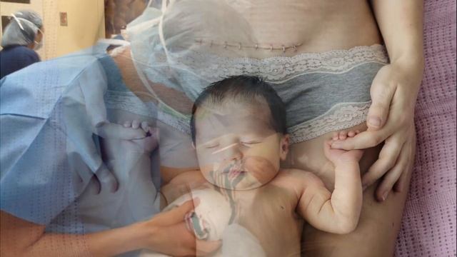 ЭКСТРЕННОЕ КЕСАРЕВО СЕЧЕНИЕ | Как можно подстраховаться на случай экстренного кесарева сечения