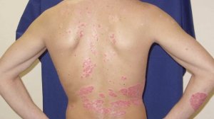 Псориаз на руках: фото начальной стадии, симптомы на пальцах рук