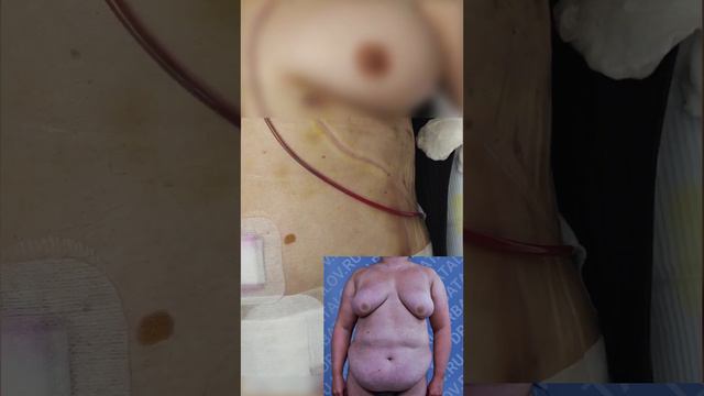 Липосакция + абдоминопластика