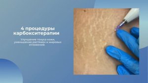 Инъекционная карбокситерапия в области растяжек.