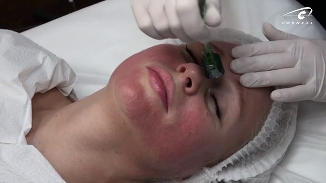 Первые ощущения от микронидлинга самые особенные смотреть онлайн