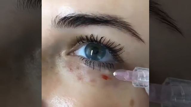 Биоревитализация, репарация и регенирация в одной процедуре для периорбитальной зоны.