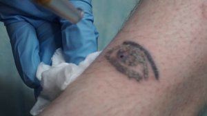 Вторая Процедура Удаления Татуировки