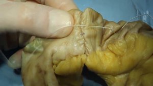 Кишечный анастомоз.   Часть III.