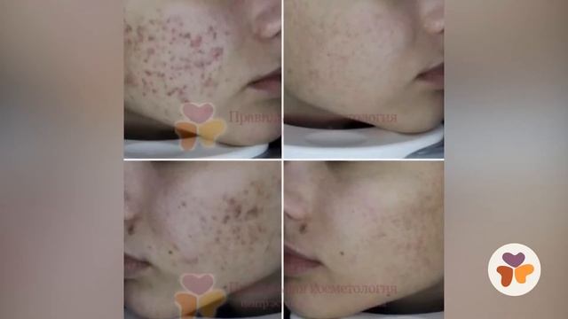 Лечение акне  Примеры работ