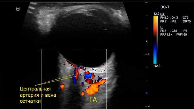Эхографическая методика проведения ТКДС. Дерзайте и вам понравится!! смотреть онлайн