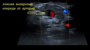 Повреждение поперечной артерии шеи с формированием 2 ложных аневризм