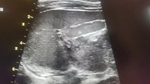 Узи селезенки, добавочная селезенка *