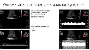 Особенности настройки УЗ аппаратуры и оптимизация допплеровского изображения. 2 часть