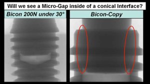 Микроподвижность в системе абатмент-имплантат. Причины и последствия
