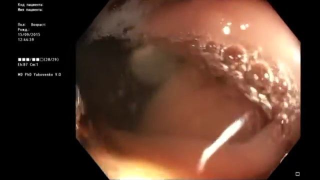 Difficult Colon EMR In Retroflection Трудная эндоскопическая резекция при колоноскопии