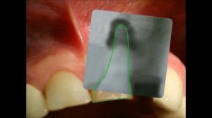 Что такое свищ  Как лечить свищ над зубом  Периодонтит  Стоматология