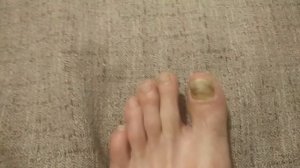 Отбитый ноготь на ноге часть 5 без докторов