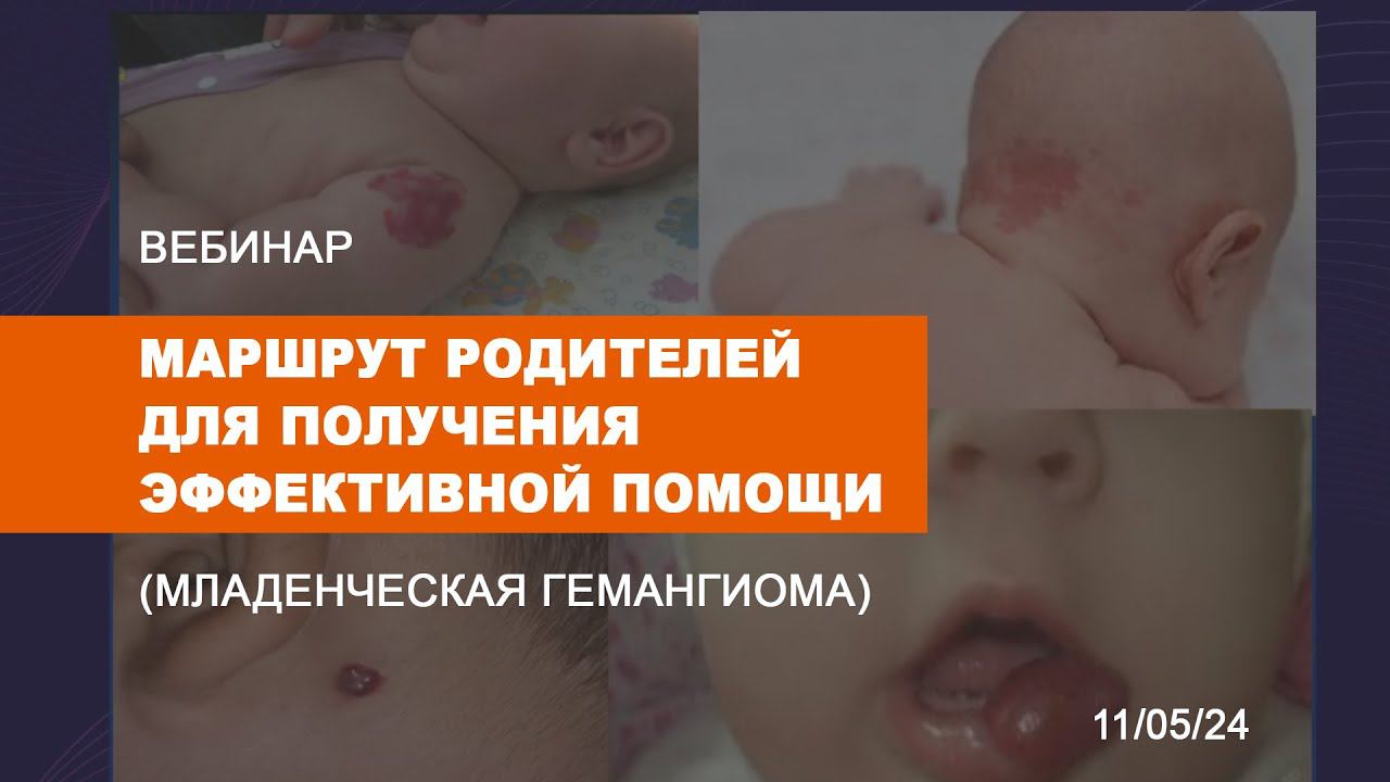 МЛАДЕНЧЕСКАЯ ГЕМАНГИОМА МАРШРУТ РОДИТЕЛЕЙ ДЛЯ ПОЛУЧЕНЯ ЭФФЕКТИВНОЙ ПОМОЩИ