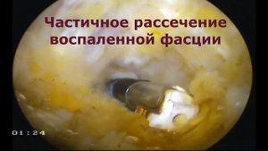 Хирургическое лечение подошвенного фасциита ("пяточной шпоры")