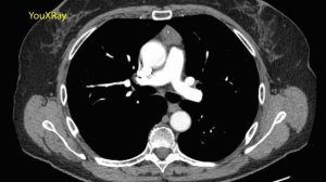 Опухоли и кисты средостения на КТ