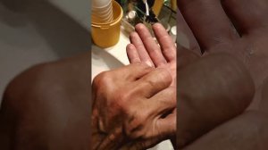 Лечение рваной раны на руке: день третий