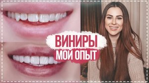 ВИНИРЫ | МОЯ ИСТОРИЯ | КАК ИЗМЕНИЛАСЬ МОЯ ЖИЗНЬ