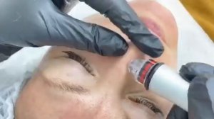 процедура Гидропилинга