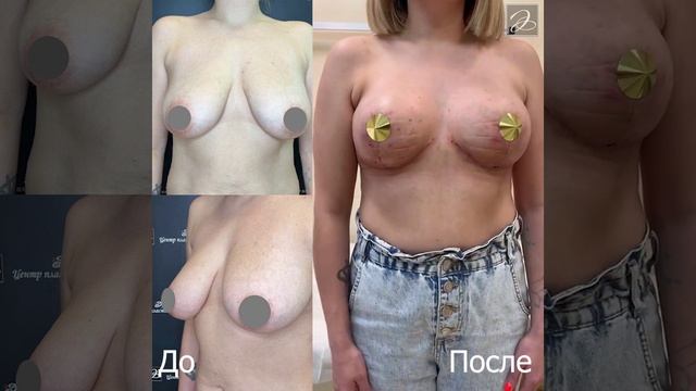 Аугментационная маммопластика с подтяжкой
