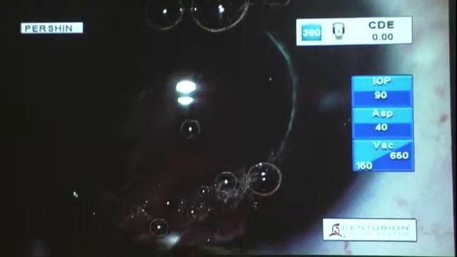 Факоэмульсификация на Centurion с фемтосопровождением LenSx, ИОЛ Acrysof Restor Toric 2.5 смотреть онлайн