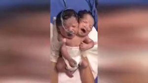 Мальчик мутант с двумя головами родился в Мексике: видео