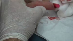 Worst Nail Infections of All Time!  Paronychia