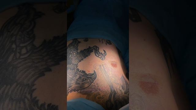 Устранение гинекомастии у мужчины результат на операционном столе💪🏽