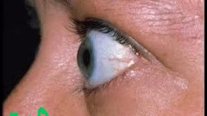 Щитовидка! Избыток и недостаток гормонов.