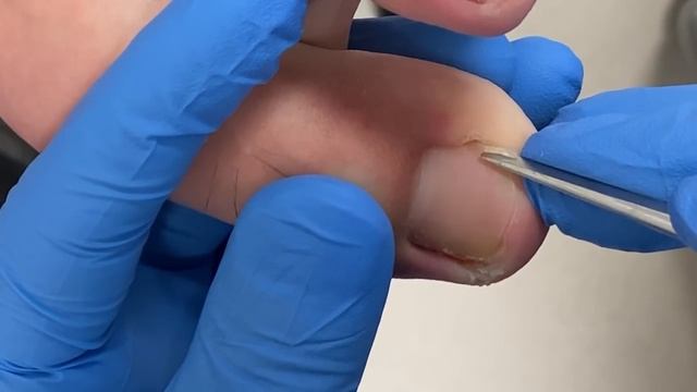 Large ingrown toenail at the base of the toenail, painful【Xue Yidao】 смотреть онлайн