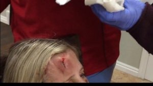 всякие бякушки #27 - огромная гематома (шишка) на лбу