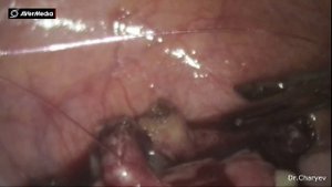 Аппендикулярный инфильтрат