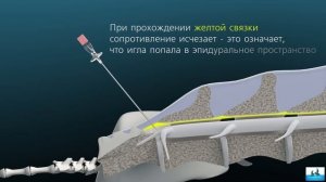 Эпидуральная анестезия. Epidural Anesthesia 3D