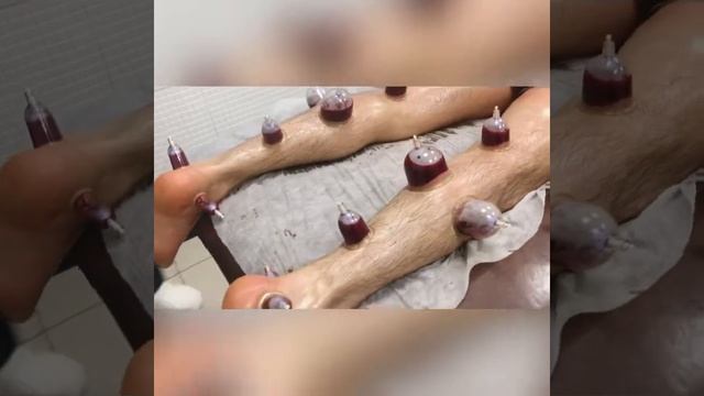 Хиджама хичома Hijama