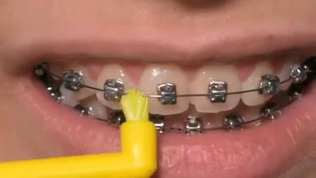 Уход за брекетами. Как чистить брекеты? монопучковая щётка Curaprox Solo.