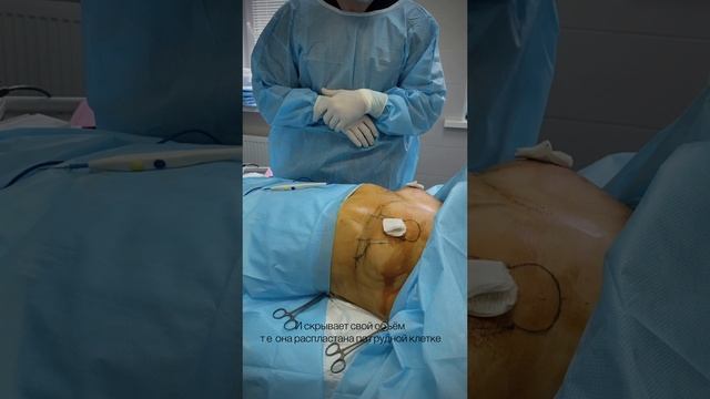 Якорная подтяжка груди без имплантов / на операционном столе / подготовка к пластической операции