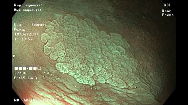 Laterally spreading tumor (LST-NG) of the caecum. Латерально распространяющаяся опухоль. смотреть онлайн