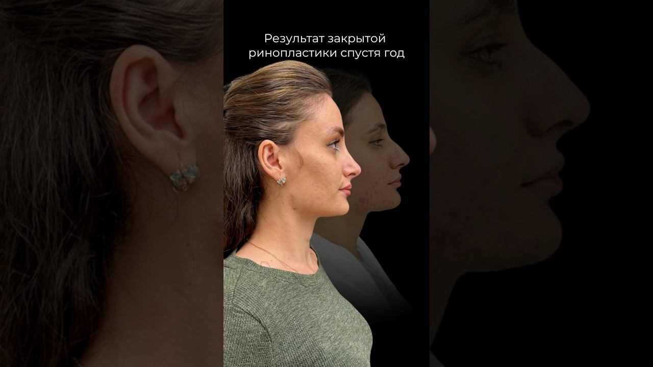 Закрытая ринопластика спустя год #ринопластикаспб #ринопластика #пластиканоса #пластическийхирург